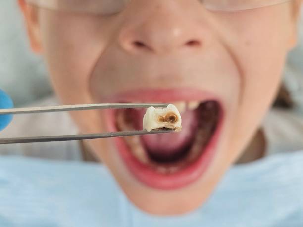 Best Emergency Wisdom Teeth Removal in Loudoun Lley Estates, VA